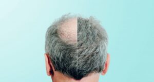 What You Need to Know About NeoGraft Hair Transplants