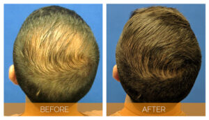 What You Need to Know About NeoGraft Hair Transplants
