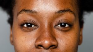 Dermatologists Explain the Best Laser Treatments for Dark Skin Tones