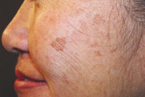 Laser Treatment for the Removal of Dark Spots