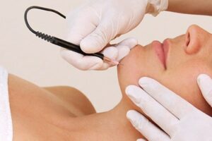 What Is Electrolysis Hair Removal, And Why You Should Consider It