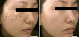 Laser Treatment for the Removal of Dark Spots