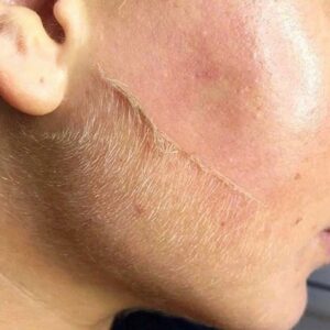 The Benefits Of A Dermaplaning Facial And How Should It Be Done