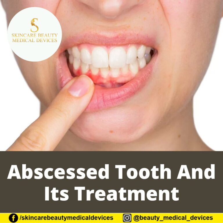 Abscessed Tooth And Its Treatment