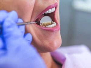 Abscessed Tooth And Its Treatment