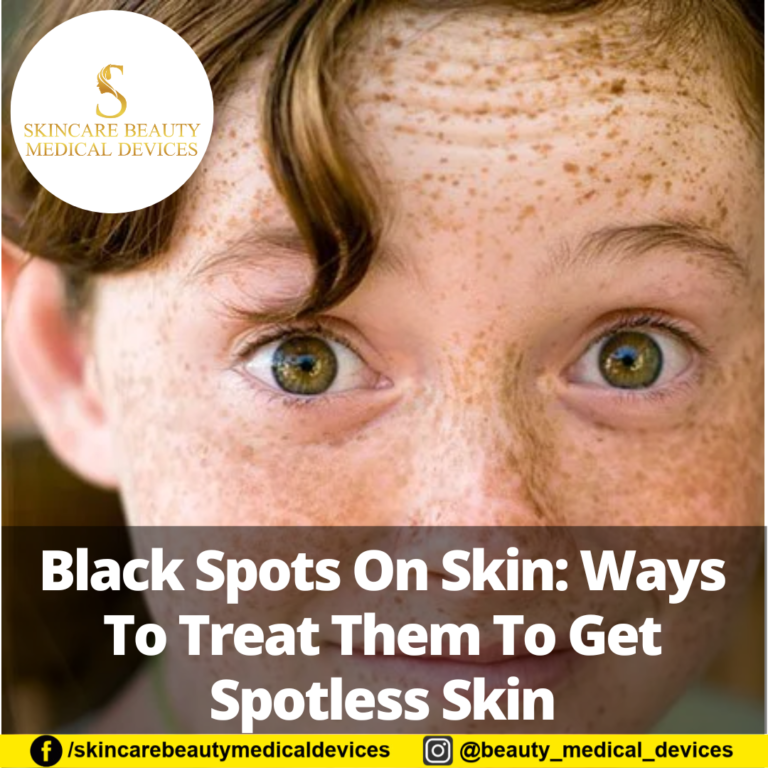 Black Spots On Skin: Ways To Treat Them To Get Spotless Skin