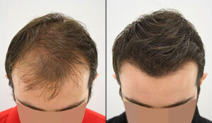 The Best Treatments For Hair Loss