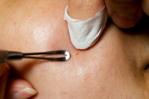 Reasons Why You Should Be Interested In A Facial Extraction Session