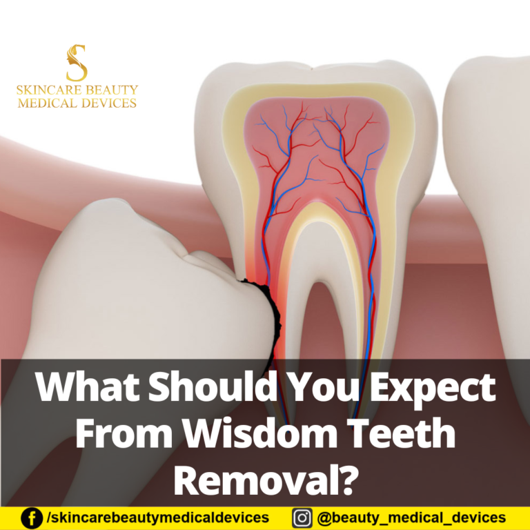 What Should You Expect From Wisdom Teeth Removal?