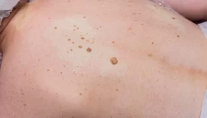 Everything About Seborrheic Keratosis And Its Treatments