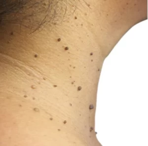 Everything About Seborrheic Keratosis And Its Treatments