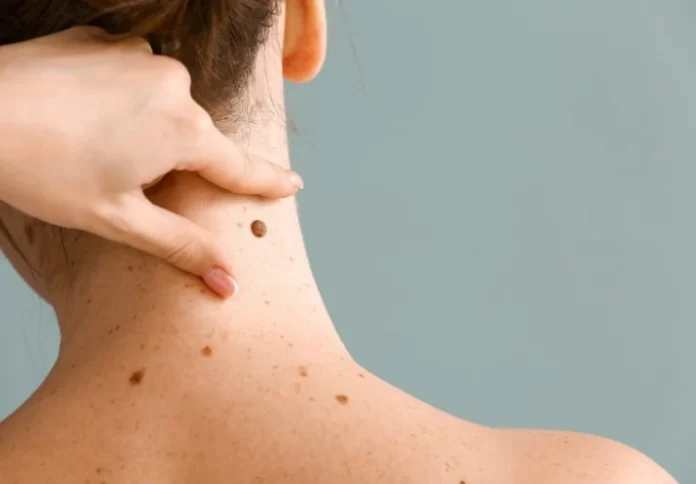 Everything About Seborrheic Keratosis And Its Treatments