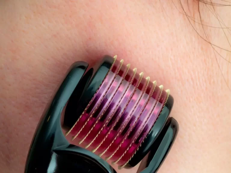 Microneedling – The Best Options Available In The Market Today