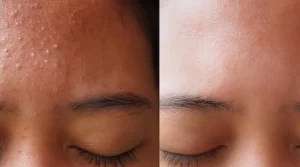All About Fungal Acne And Its Treatments 