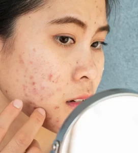 All About Fungal Acne And Its Treatments 