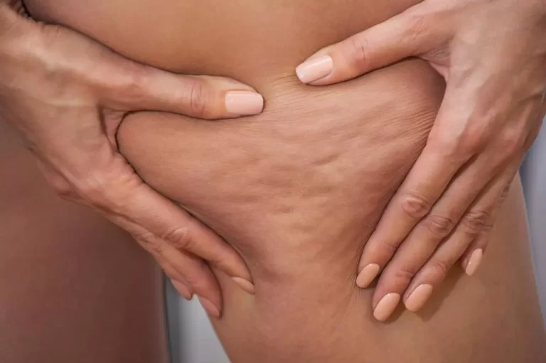 Cellfina: The Cellulite Treatment You Need To Know About