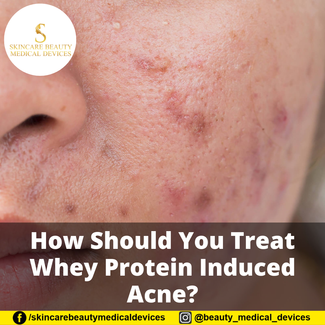 How Should You Treat Whey Protein Induced Acne?