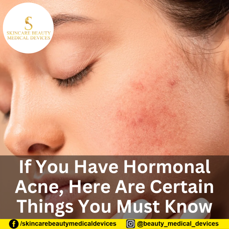 If You Have Hormonal Acne, Here Are Certain Things You Must Know
