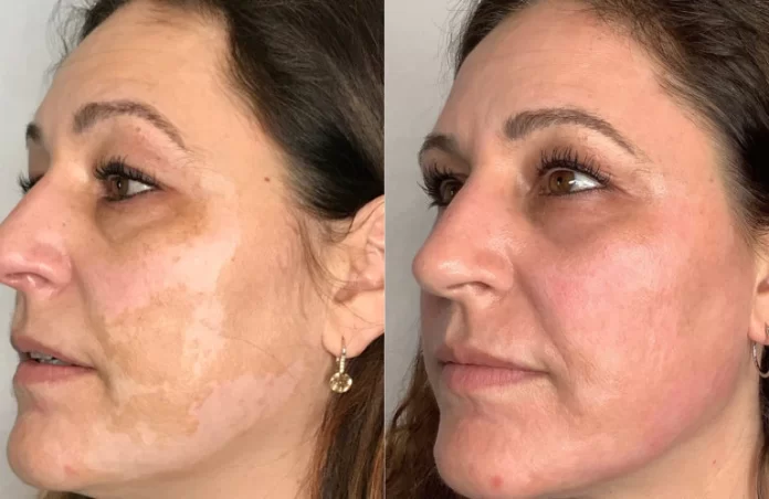 Pearl Fractional Laser Treatment: The Key to Radiant, Youthful Skin
