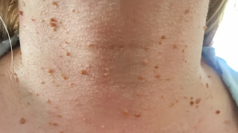 Skin Tags 101: Causes, Diagnosis, and Safe Removal Methods