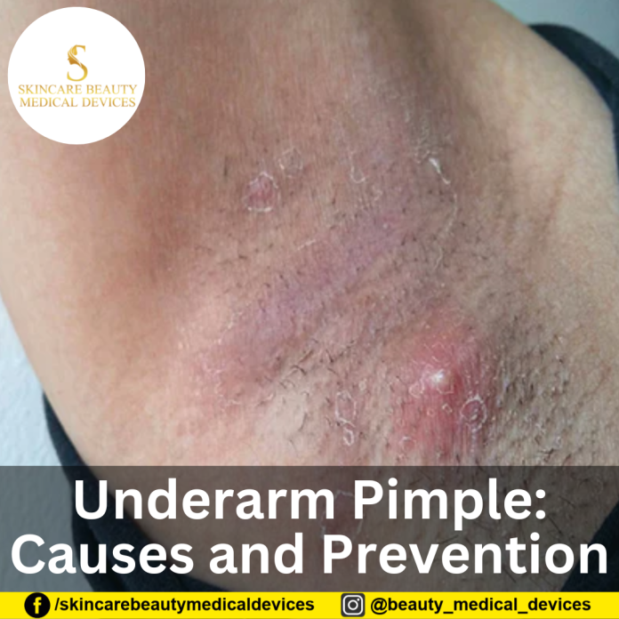 Underarm Pimple Causes and Prevention Underarm Pimple: Causes and Prevention