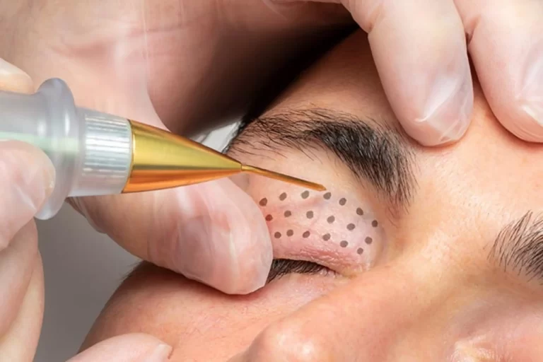 Discover the Magic of Jett Plasma Eye-Lift Therapy: The Secret to Radiant Eyes