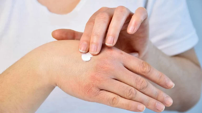 Devices To Improve Psoriasis And How They Work: A Comprehensive Guide