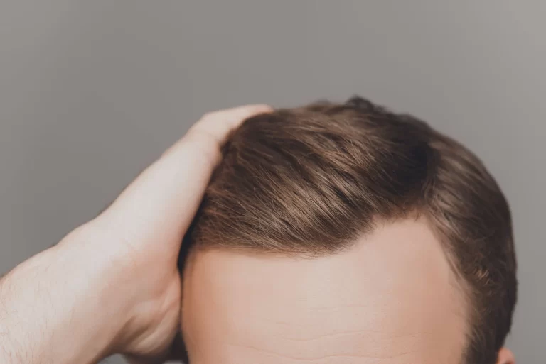 Hairline Tattoo: The Ultimate Solution for Permanent Hair Loss Treatment