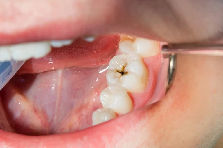 The Ultimate Guide to Healing Tooth Decay: 6 Easy Steps