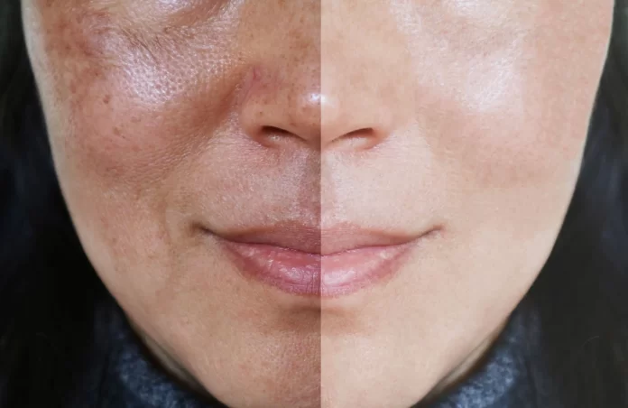 All You Need to Know About HydraFacial and Its Benefits