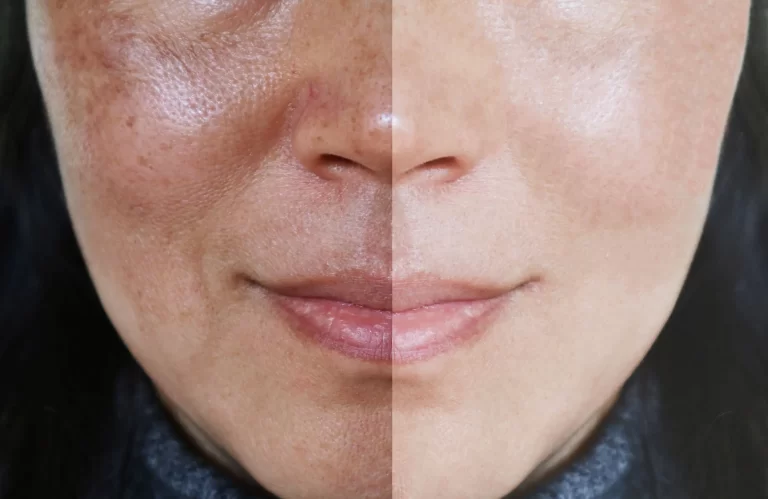 All You Need to Know About HydraFacial and Its Benefits