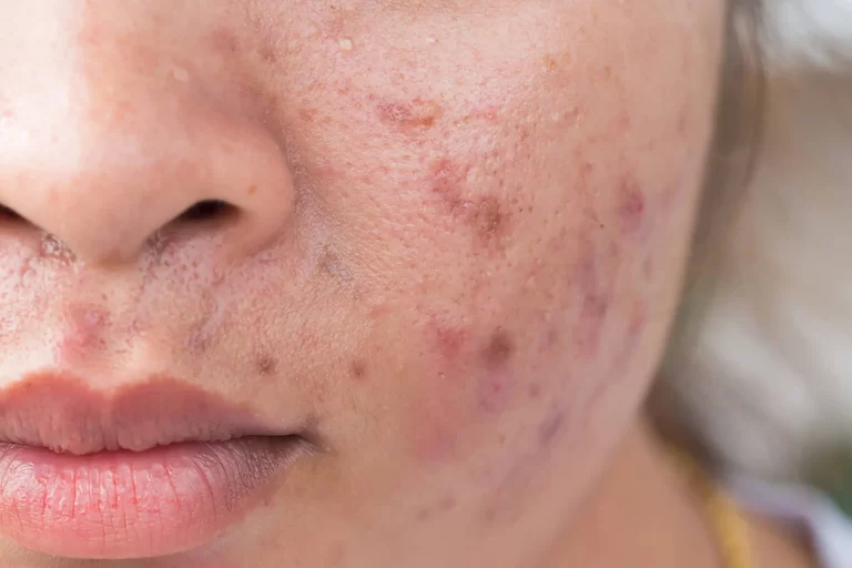 Managing Acne Caused by Whey Protein: Dos and Don’ts