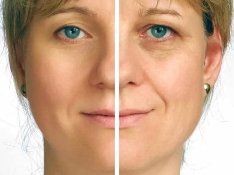 Facelift vs Thread Lift: Which is Right for You?