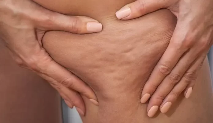 The Ultimate Guide to Cellulite: Causes, Treatments, and Prevention