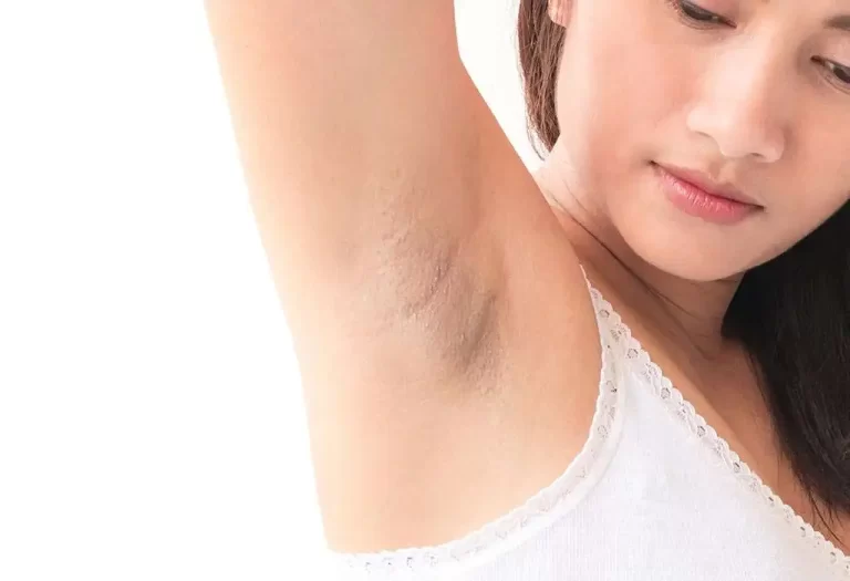 The Ultimate Guide to Lightening Dark Underarms: 5 Effective Methods