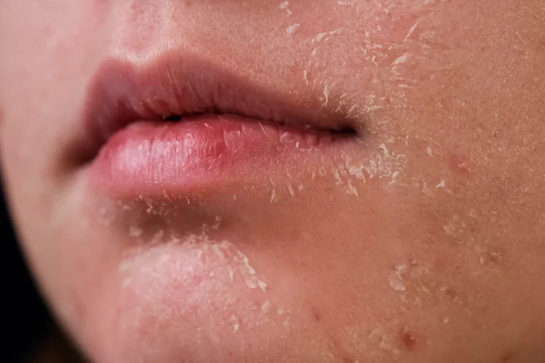 From Flaky to Fabulous: How to Restore Dry, Cracked Skin