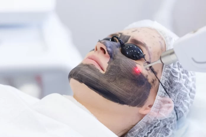 Unlock the Benefits of a Laser Carbon Peel: A Comprehensive Guide