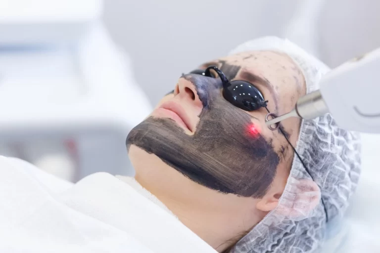 Unlock the Benefits of a Laser Carbon Peel: A Comprehensive Guide