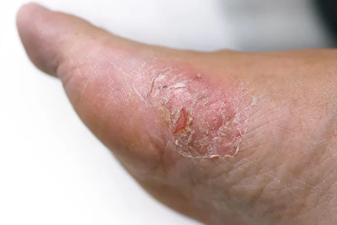 Skin Deep: How Skin Lesions Can Help Diagnose Diabetes