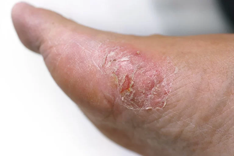Skin Deep: How Skin Lesions Can Help Diagnose Diabetes