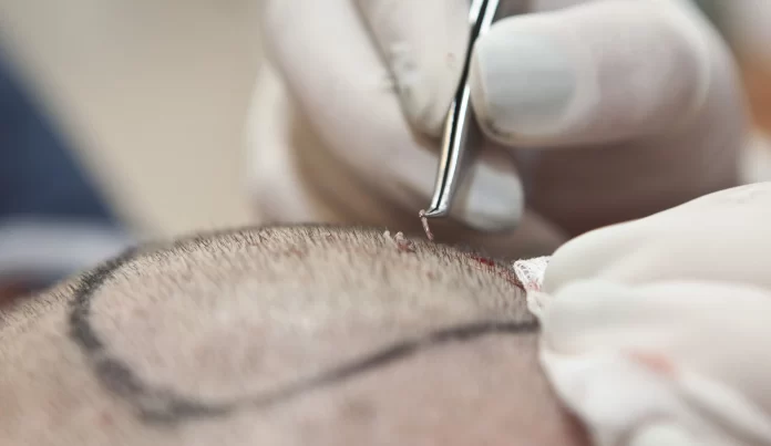 The Complete Guide to Hair Transplant Surgery