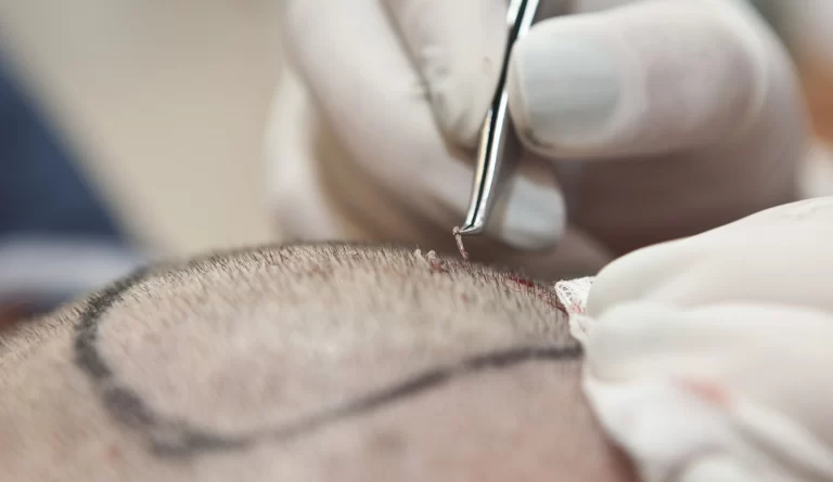 The Complete Guide to Hair Transplant Surgery