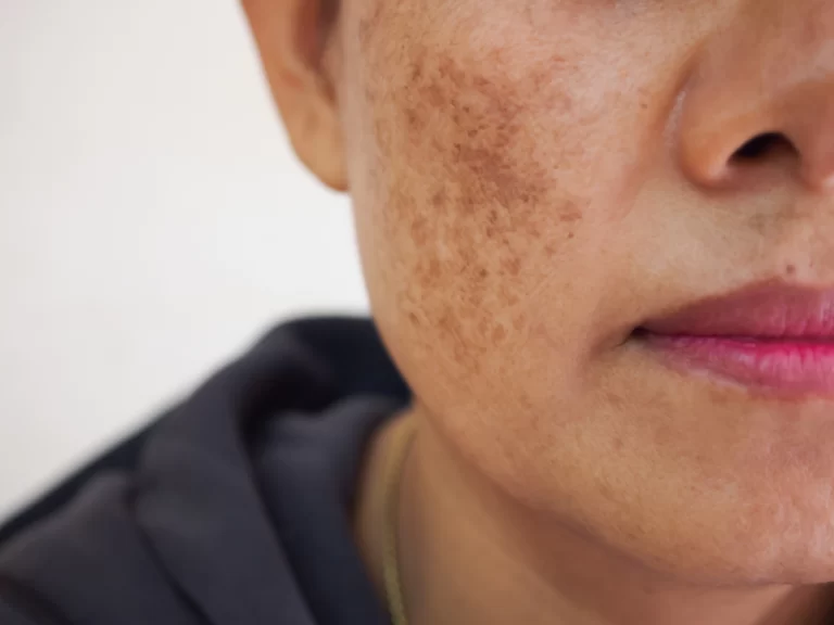 Say Goodbye to Skin Discoloration with Body Peels