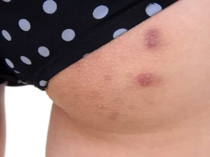 Say Goodbye to Butt Rashes with These Easy Home Remedies