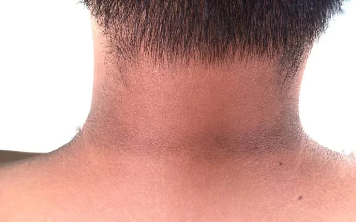 Dark Neck No More: Unlock the Power of Three Natural Remedies