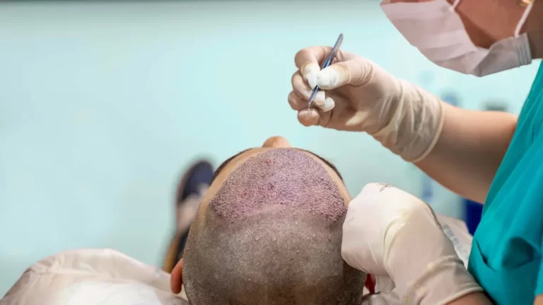 The Ultimate Guide to Hair Transplant Surgery