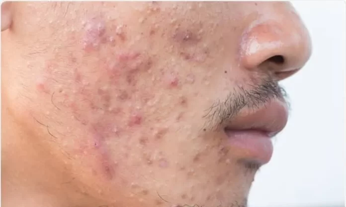 Stress Acne: The Skin Side Effect of Modern Living