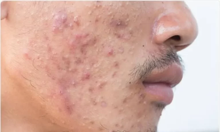 Stress Acne: The Skin Side Effect of Modern Living