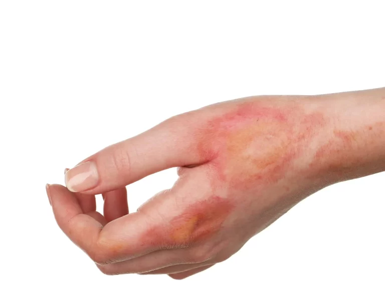 Healing the Burn: Effective Treatment Options for Burn Scars