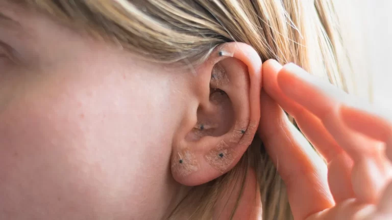 Ear Seeding for Pain Relief: What You Need to Know
